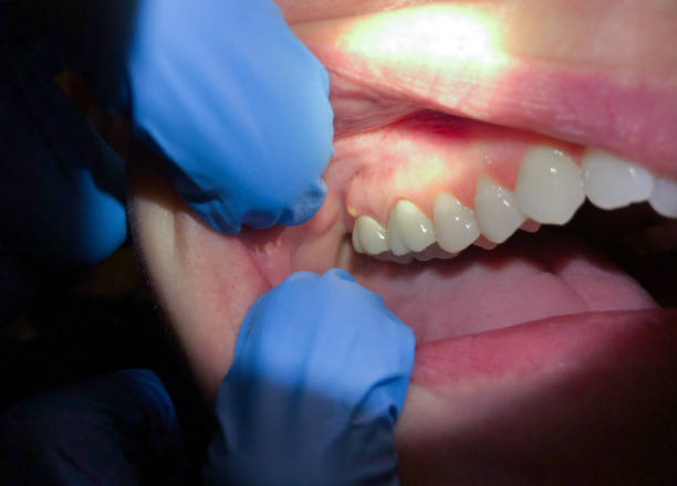 Best Emergency Care for Gum Disease in Flint Hill, MO